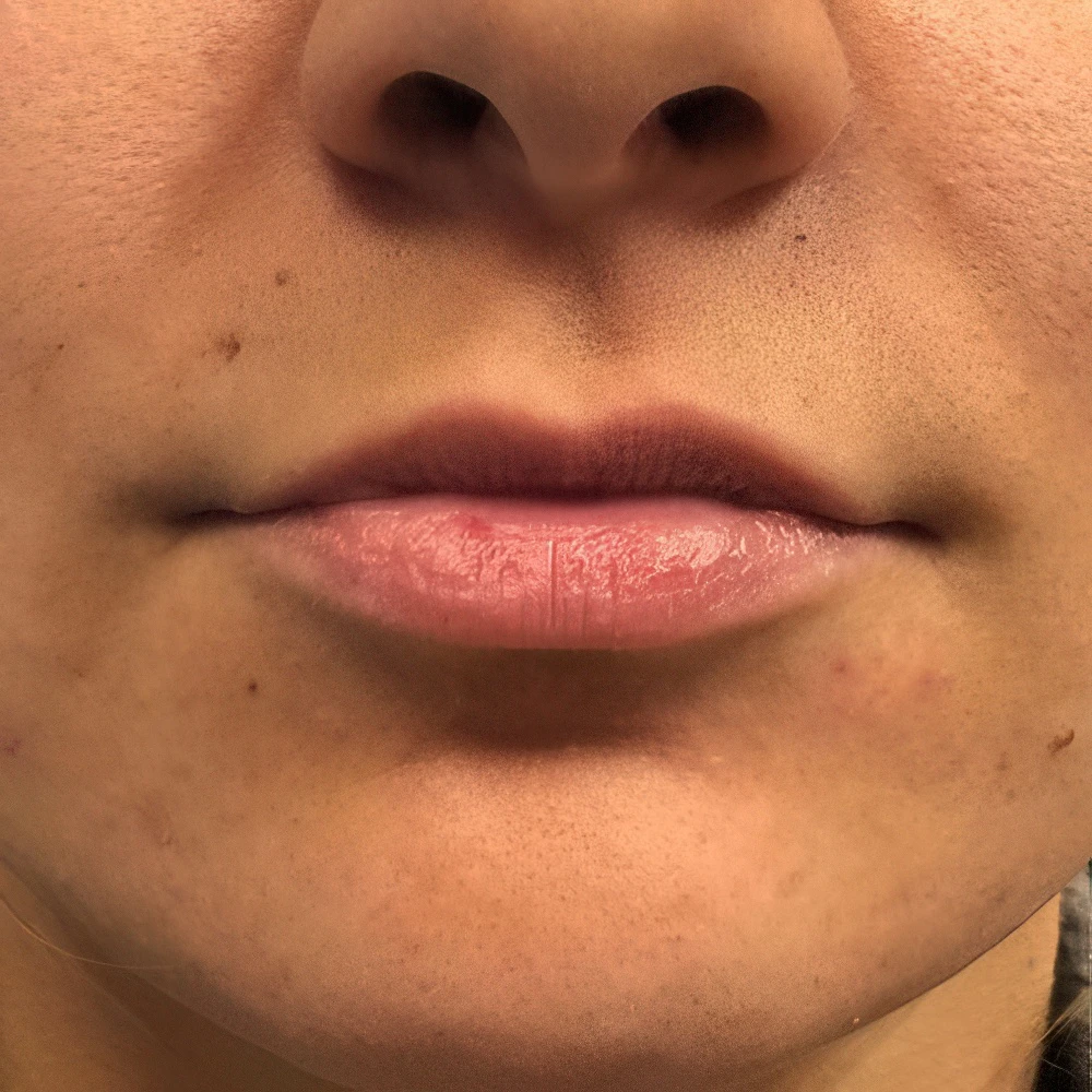 Case 13 before Lip Filler