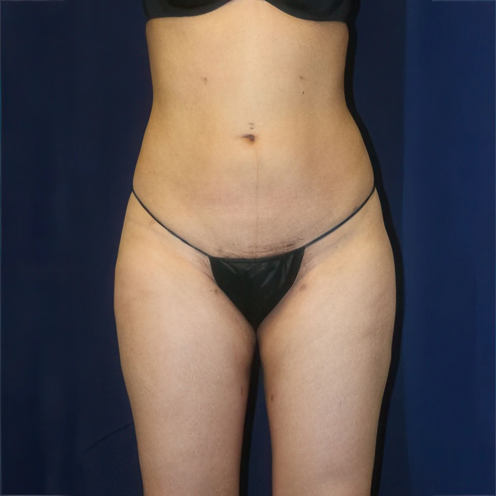 Case 40 after liposuction with Dr. James E. Murphy