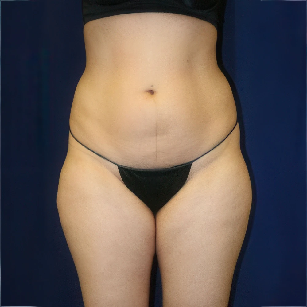 Case 40 before liposuction with Dr. James E. Murphy