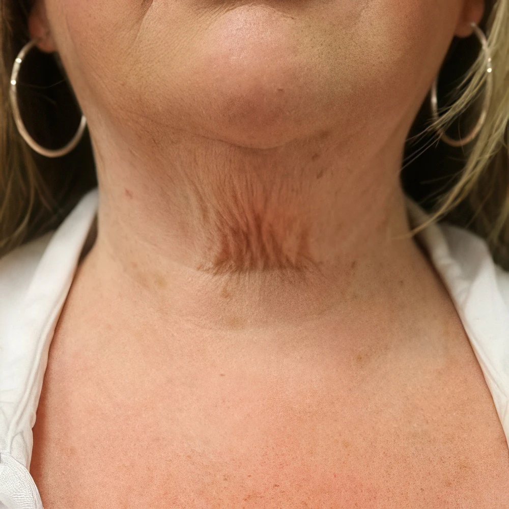 Case 3 before Potenza RF Microneedling with Dr. James E. Murphy