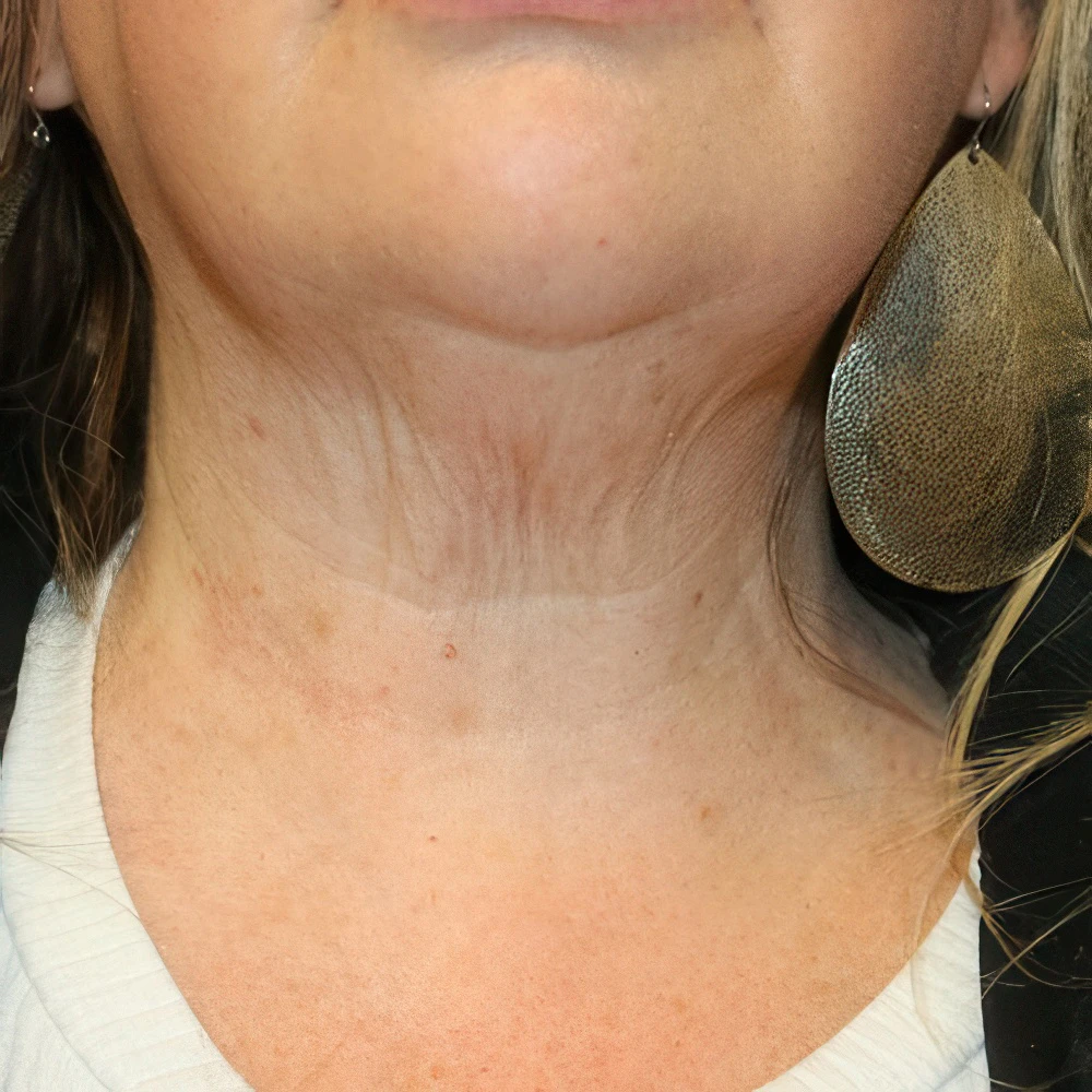 Case 3 after Potenza RF Microneedling with Dr. James E. Murphy