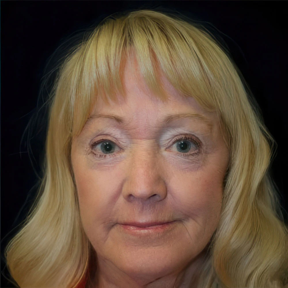 After CO2 Laser Treatment