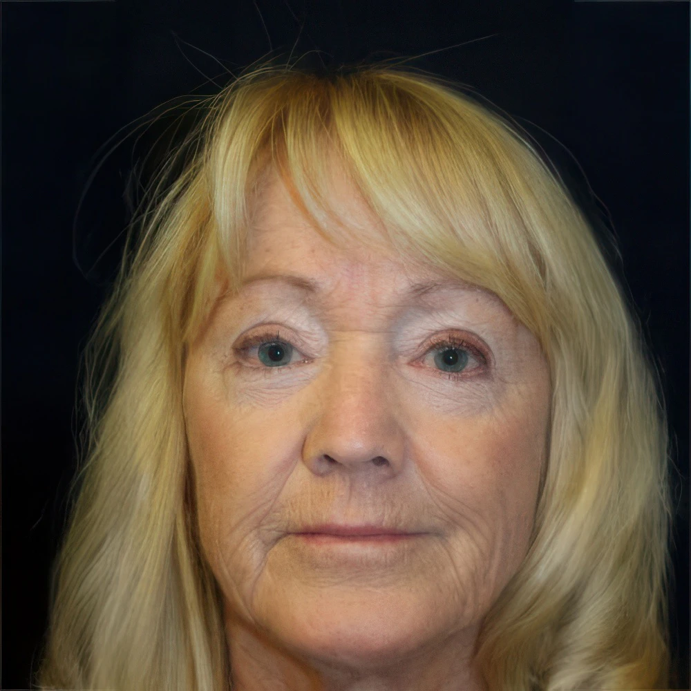 Befor CO2 Laser Treatment