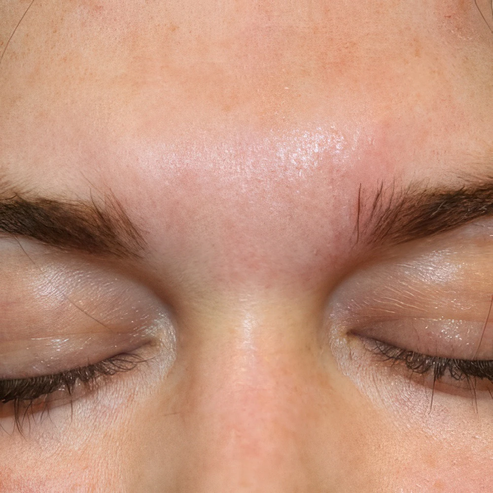 After Scar Removal