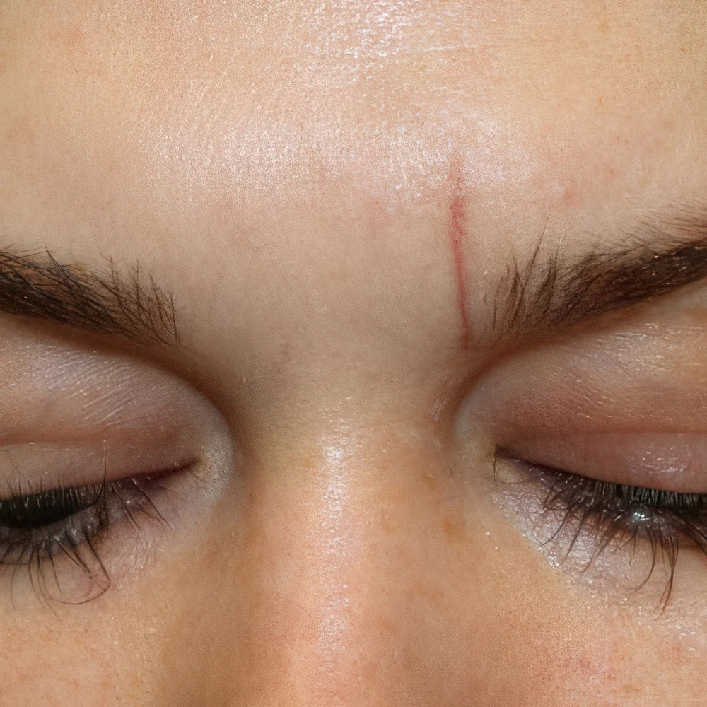 Before Scar Removal