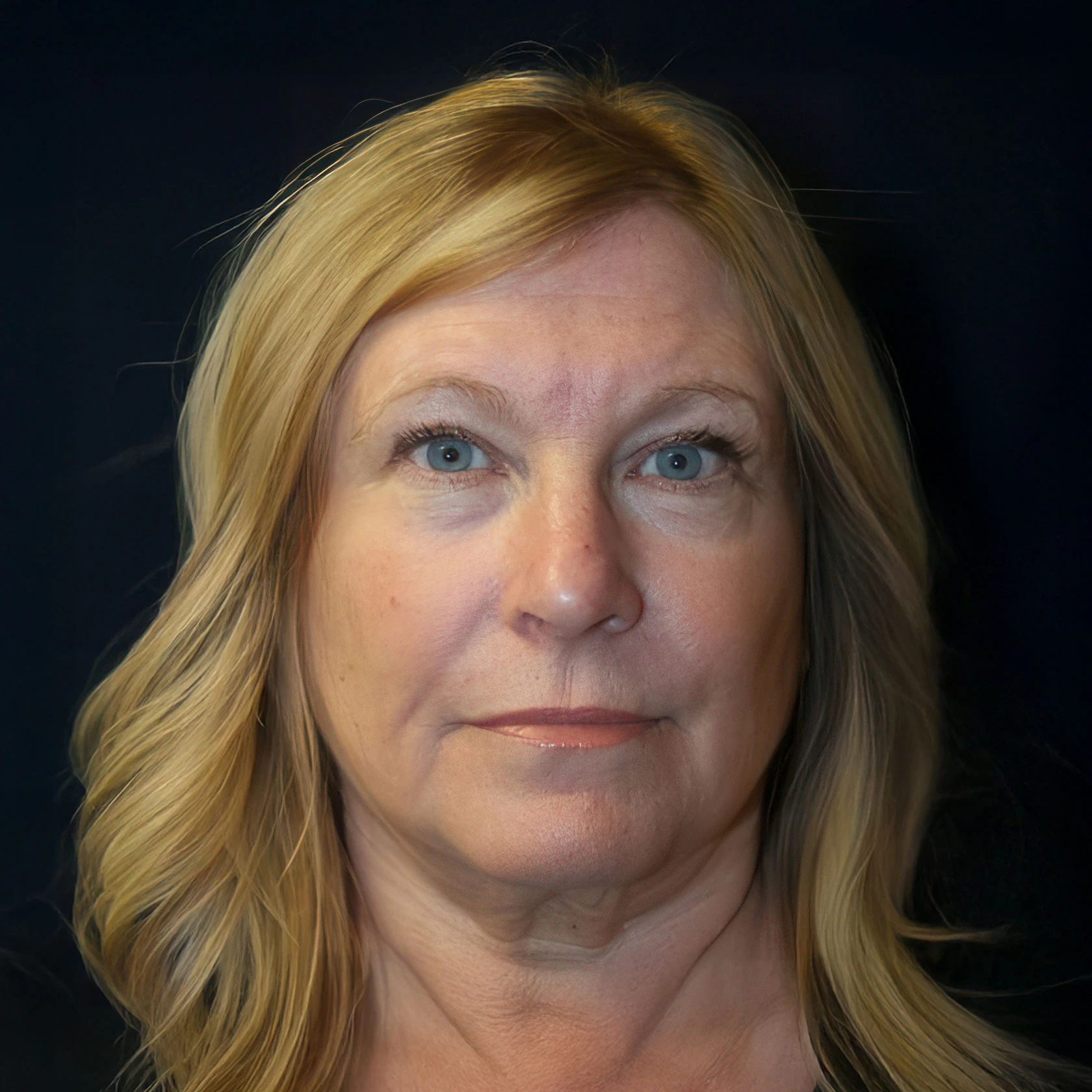 After CO2 Laser Resurfacing 