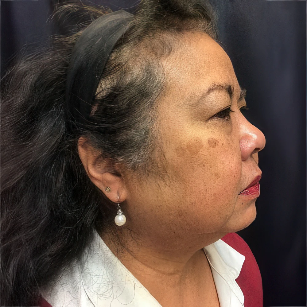 Before PicoSure