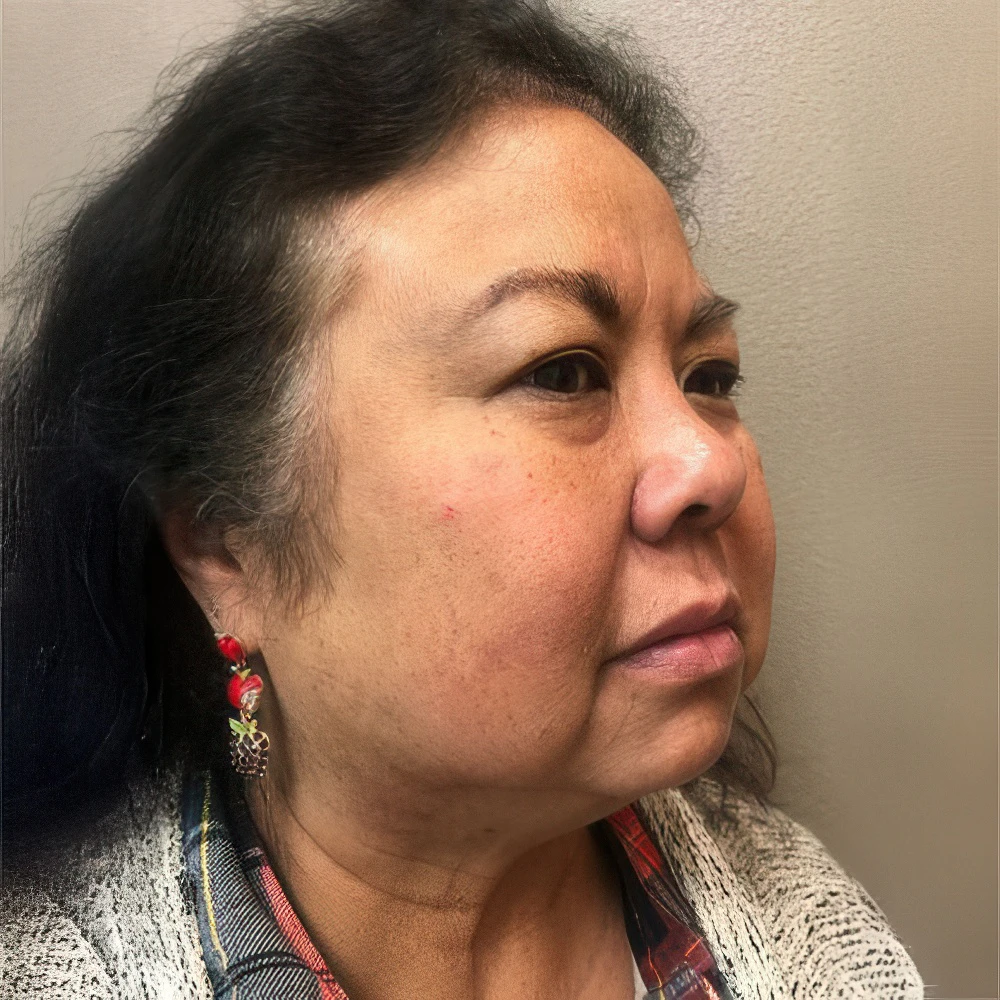 After PicoSure