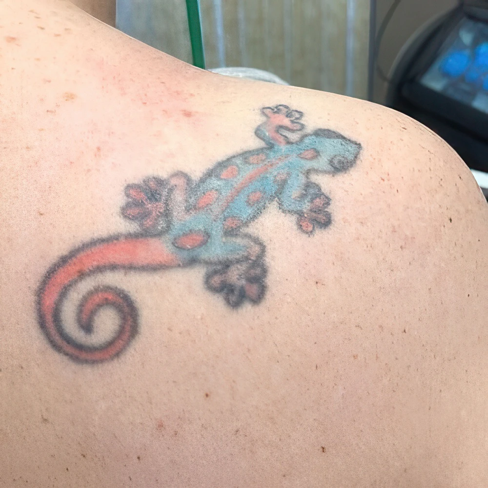 Before Tattoo Removal