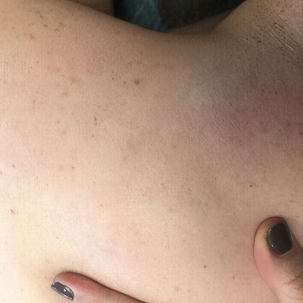 After Tattoo Removal