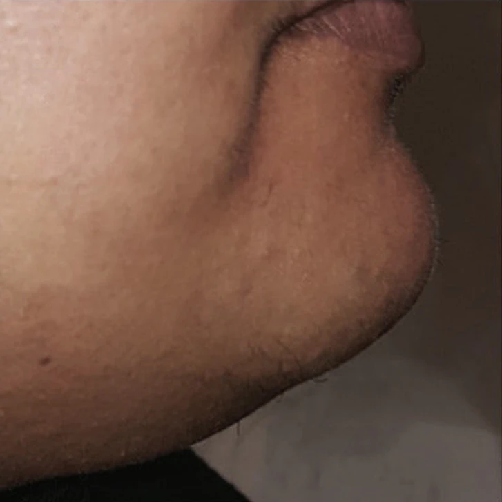After Laser Hair Removal