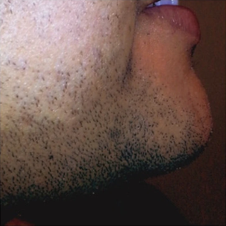 Before Laser Hair Removal