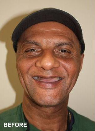 Periodontal Associates of Jackson patient with no teeth