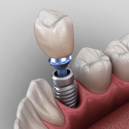 an illustration of a dental implant