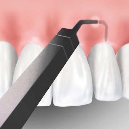 Image of Chao Pinhole Technique