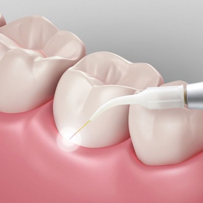 Illustration of Lanap laser