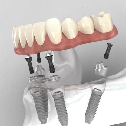 Illustration of All-on-4 restorations