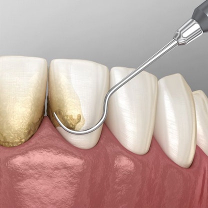 Illustration of dental cleaning