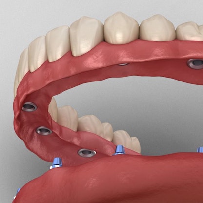 Illustration of implant-supported dentures