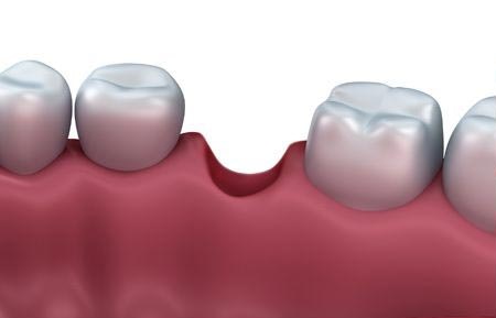 Illustration of a tooth gap before ridge augmentation