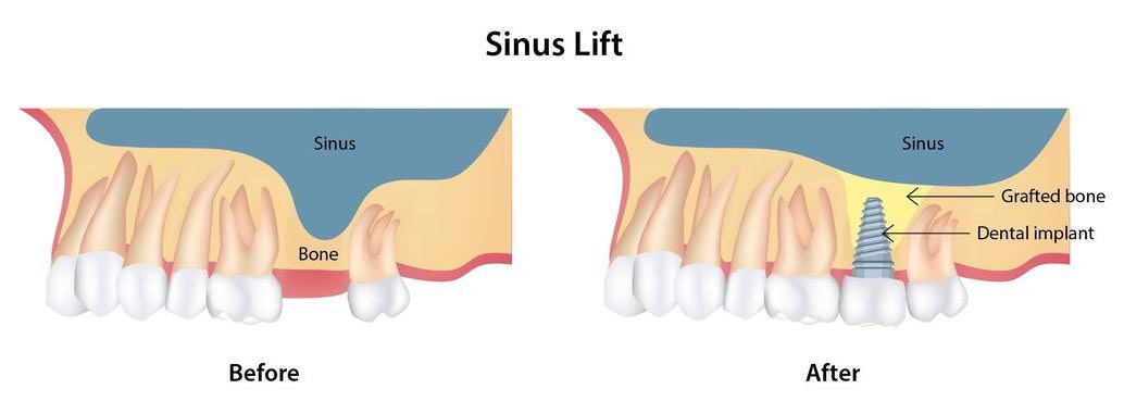 illustration of sinus lift