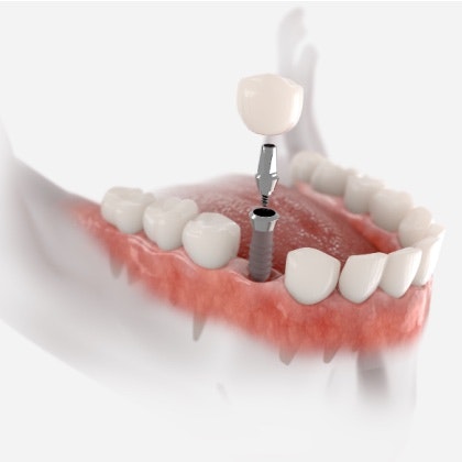 Illustration of an implant-supported crown