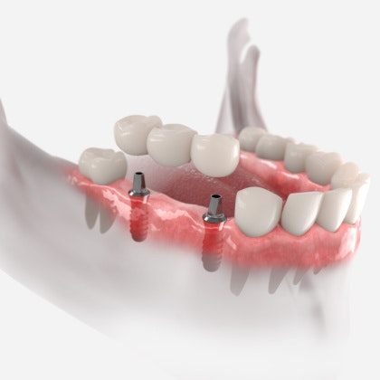 Illustration of an implant-supported bridge