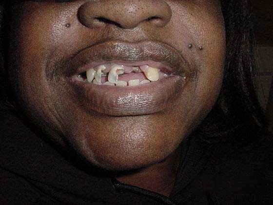 before dental implants