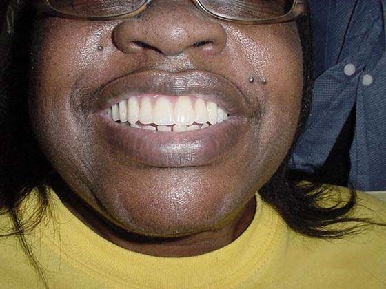 after dental implants