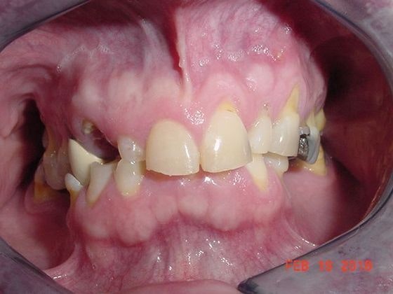 man's mouth with missing teeth