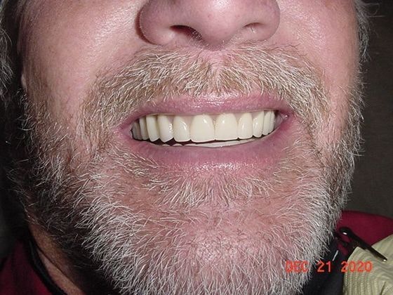 the same man with a complete smile