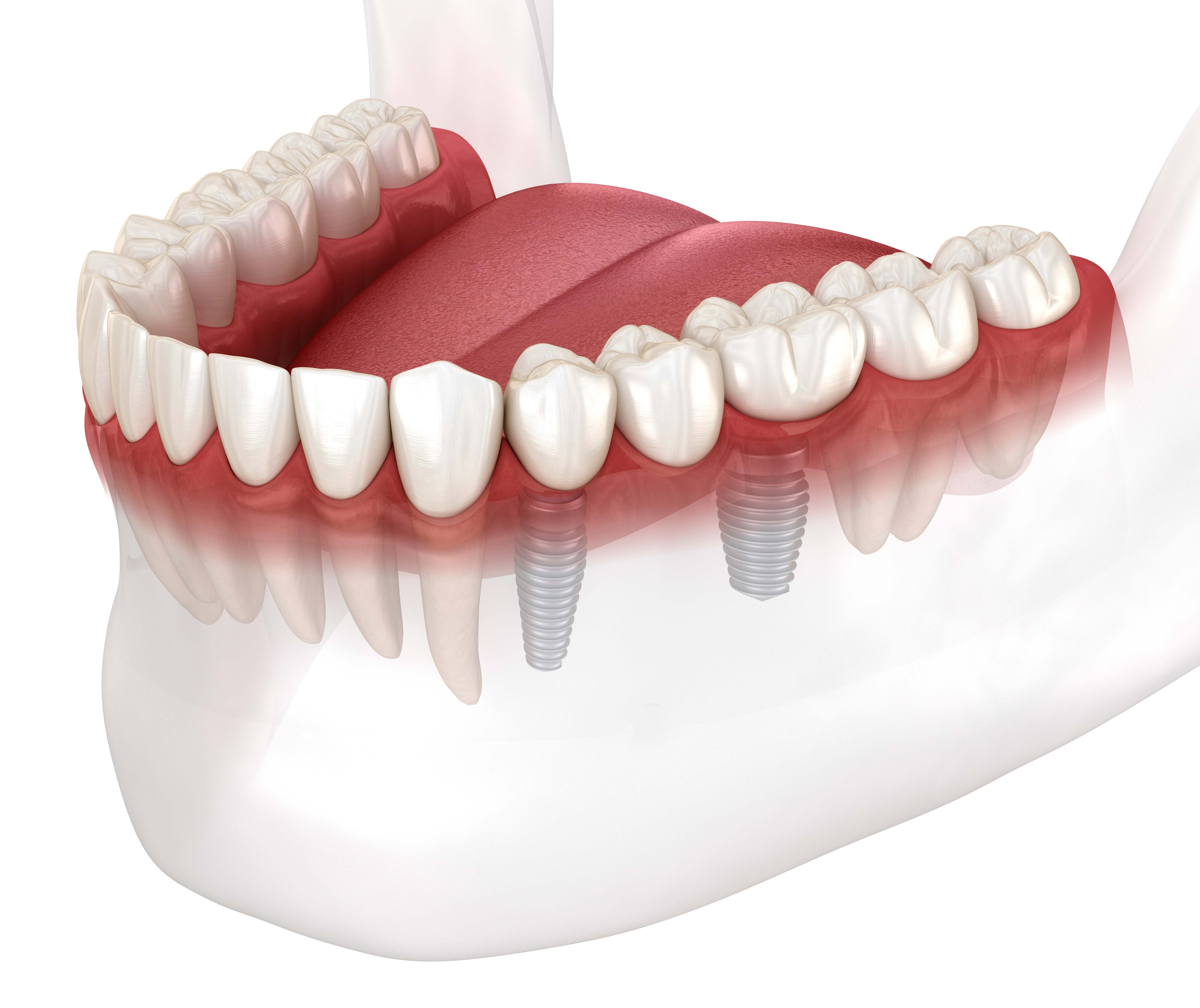 Premium Periodontics & Dental Implants
