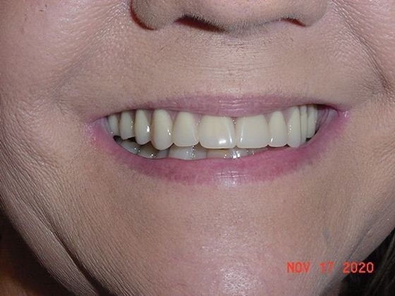 After the implants procedure