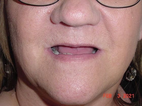 Before the implants procedure