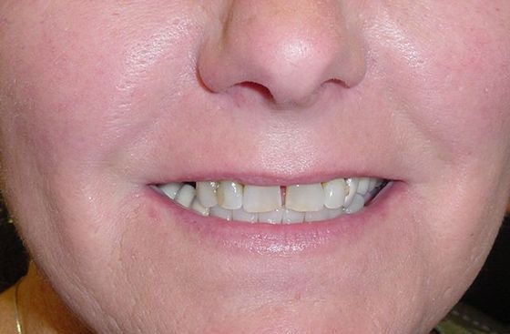 Before implant placement