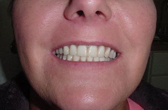 After implant placement