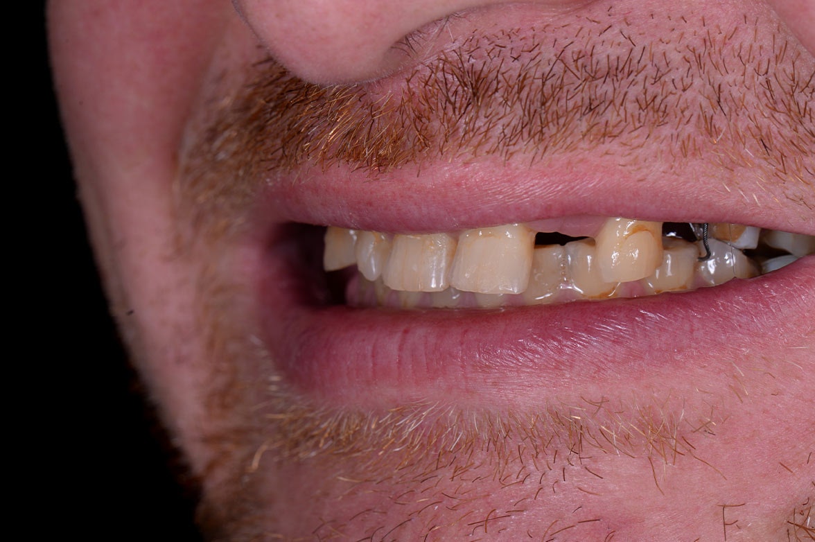 Before dental implants photo