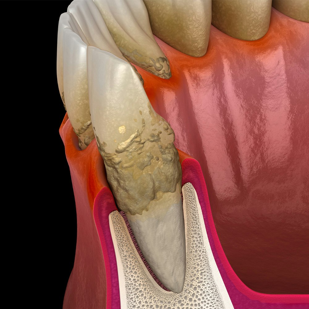 Scaling and root planing