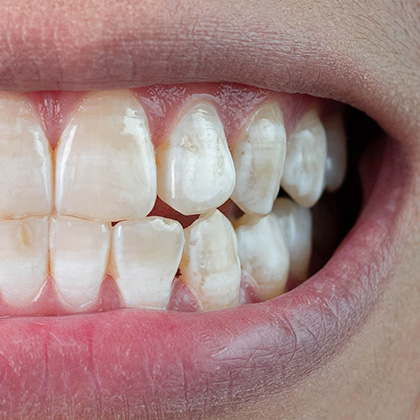 teeth with intrinsic stains