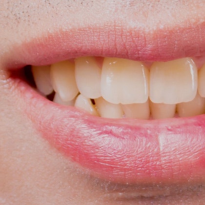 teeth with extrinsic stains