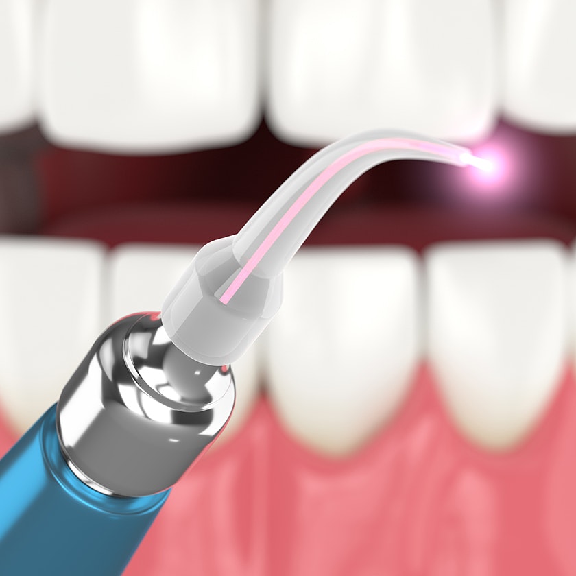 3D render of laser dentistry