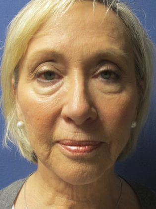 Devlin Cosmetic Surgery patient before facelift surgery