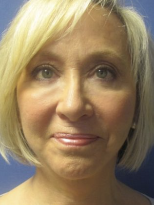 Devlin Cosmetic Surgery patient after facelift surgery