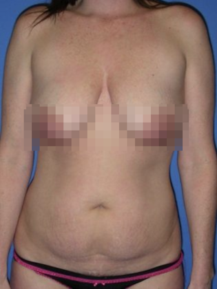Devlin Cosmetic Surgery patient before tummy tuck