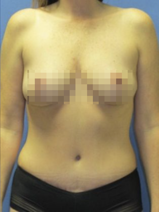 Devlin Cosmetic Surgery patient after tummy tuck