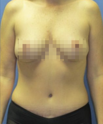 Devlin Cosmetic Surgery patient after tummy tuck