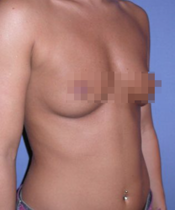 Devlin Cosmetic Surgery patient with flat breasts