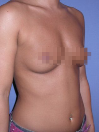 Devlin Cosmetic Surgery patient with flat breasts