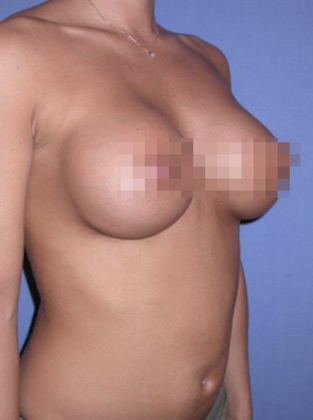 Devlin Cosmetic Surgery patient after breast augmentation