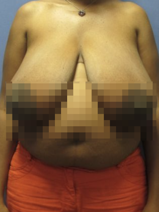 Devlin Cosmetic Surgery patient before breast lift with reduction